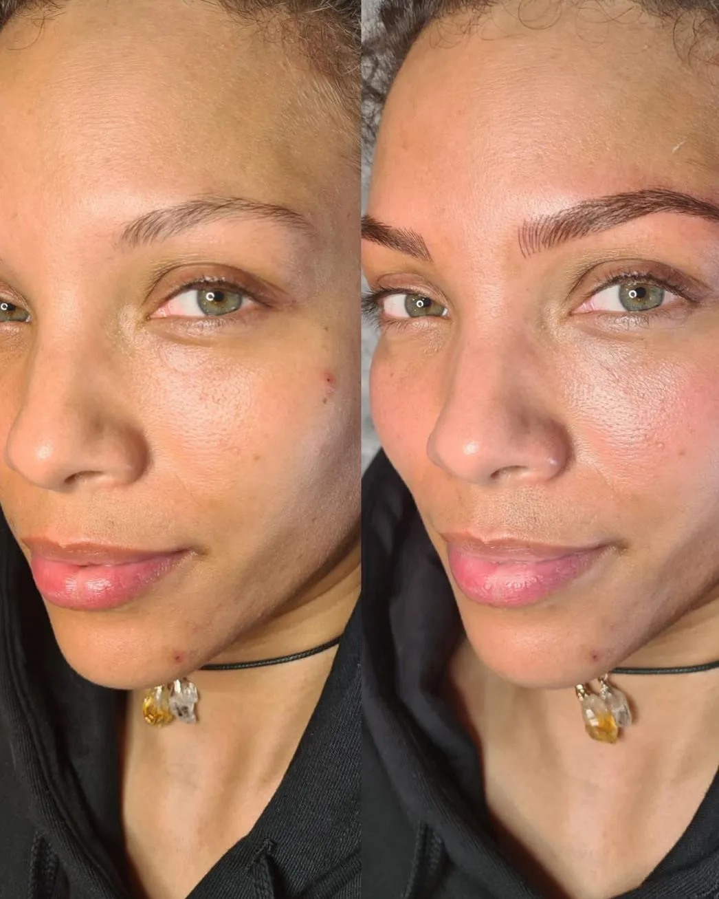 Dry Healing vs. Wet Healing